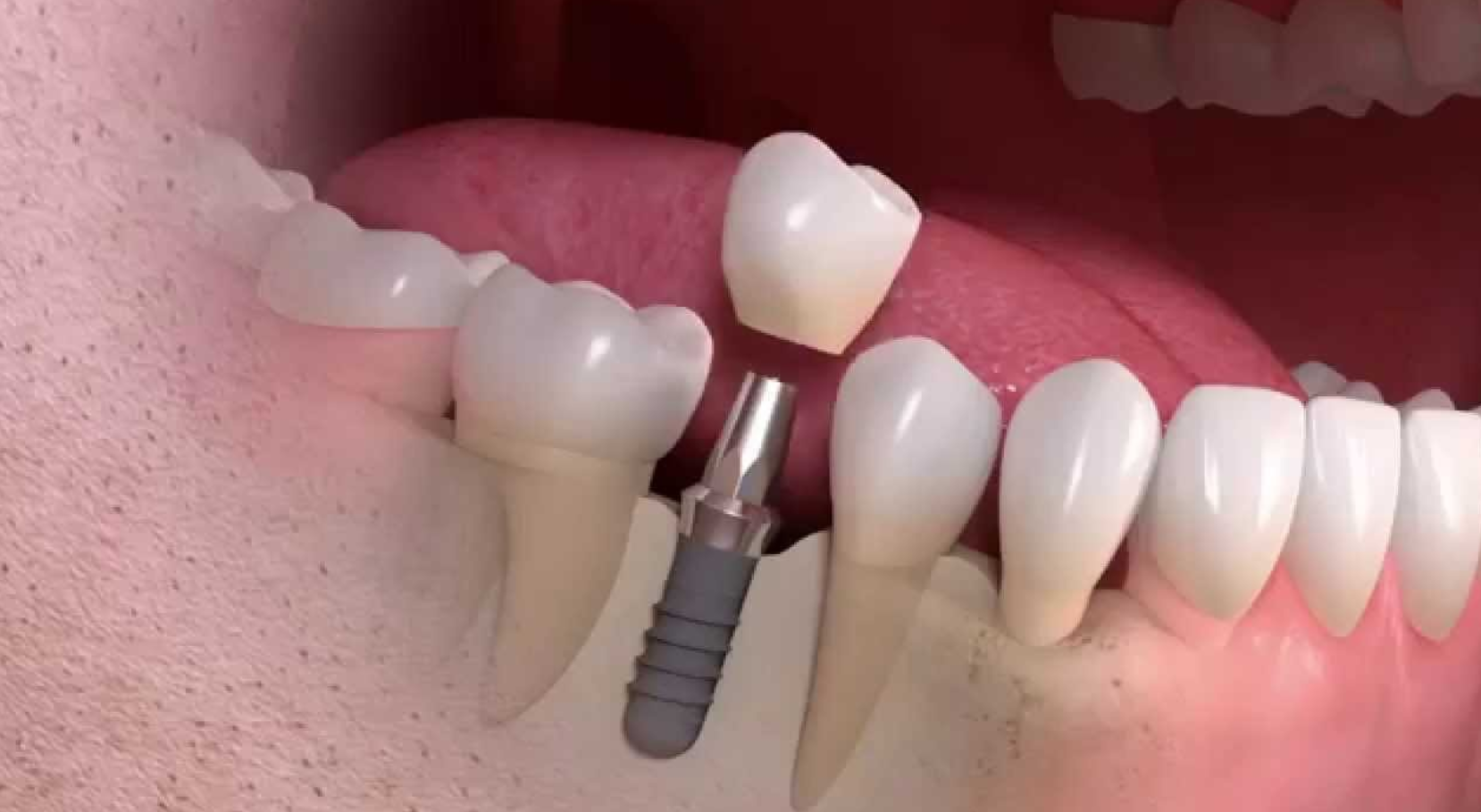 Dental Implants