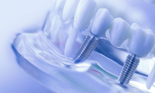 Dental Implants Lawrenceville NJ
