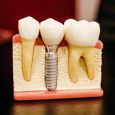Same-Day-Dental-Implants-Hamilton-NJ-Dentist
