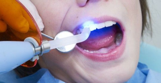 Dental Sealant Quick and Painless Procedure-Lawrenceville NJ Location