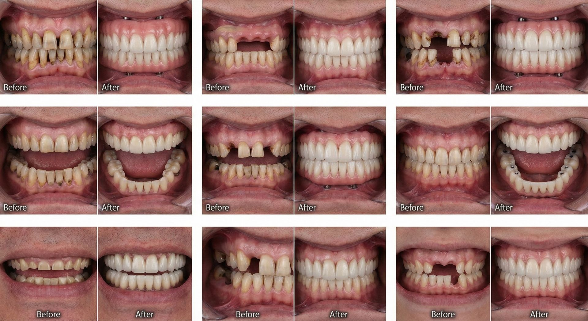 Full Arch Dental Implants Before and After - 8 Patient Cases at Deluxe Dentistry Newtown PA