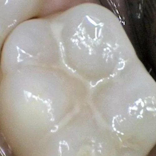Dental Sealant Applied to Lawrenceville NJ Patient's Tooth for Maximum Protection against decay