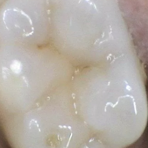 Dental Sealant Applied to Lawrenceville NJ Patient's Tooth for Maximum Protection against decay