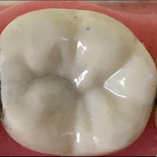Dental Sealant Applied to Lawrenceville NJ Patient's Tooth for Maximum Protection against decay