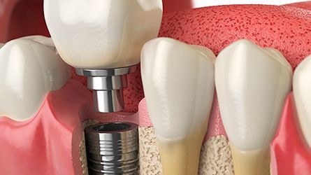Bone-Grafting-Hamilton-NJ-Dentist
