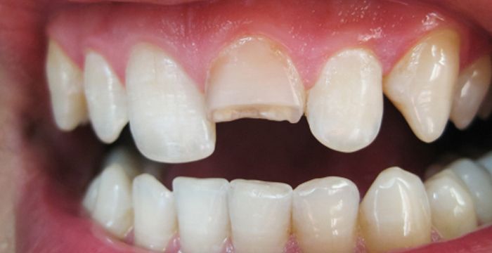 Dental-Emergency-Chipped-Broken-Tooth