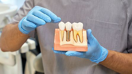 Single-Dental-Implants-Implant-Bridges-Hamilton-NJ-Dentist