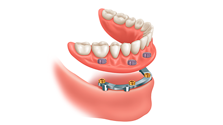 Dental-Implant-Supported-Dentures-Hamilton-NJ-Dentist