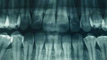 Internal-Sinus-Lift-Hamilton-NJ-Dentist