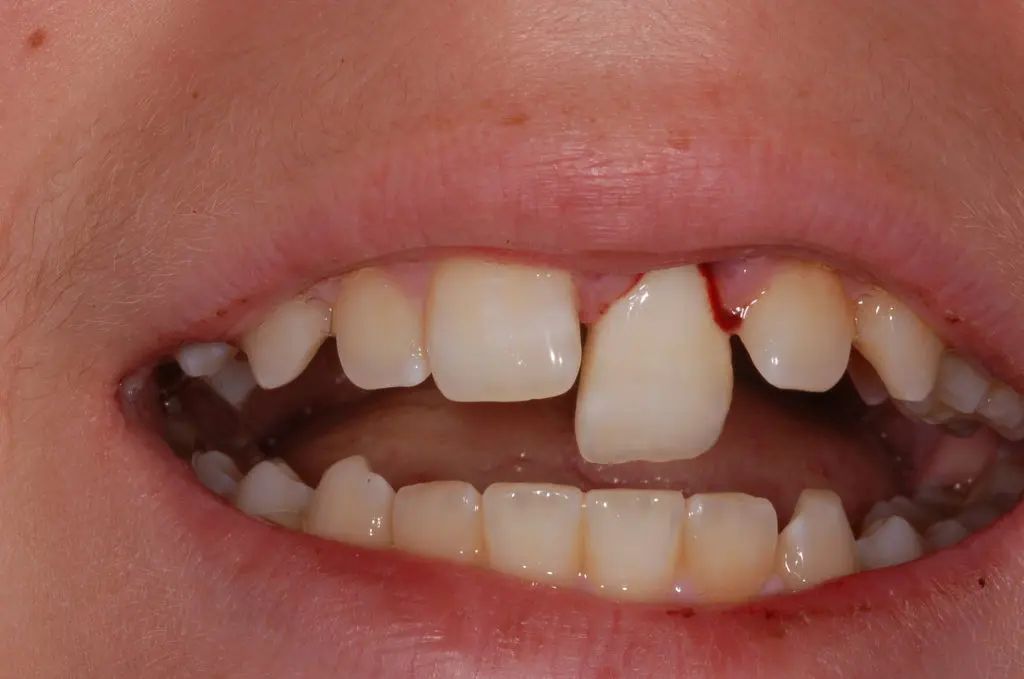 Dental-Emergency-Knocked-Out-Tooth