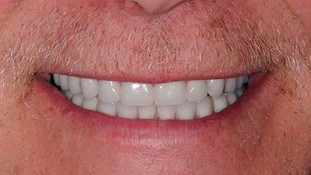 Full-Mouth-Reconstruction-Hamilton-NJ-Dentist