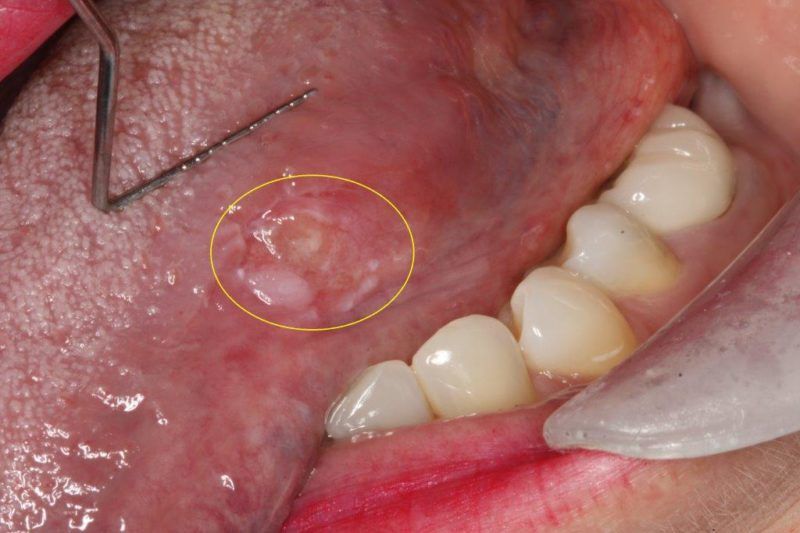 Leukoplakia detected during oral cancer screening at Deluxe Dentistry Lawrenceville NJ