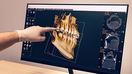 Platelet-Rich-Fibrin-Hamilton-NJ-Dentist