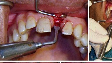 Ridge-Splitting-Hamilton-NJ-Dentist