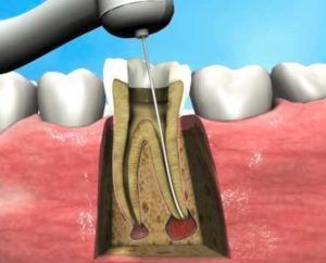 Root Canal Treatment Lawrenceville NJ