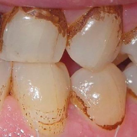Deep Cleaning-Scaling and Root Planning Dental Care.