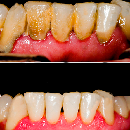 Deep Cleaning-Scaling and Root Planning Dental Care.