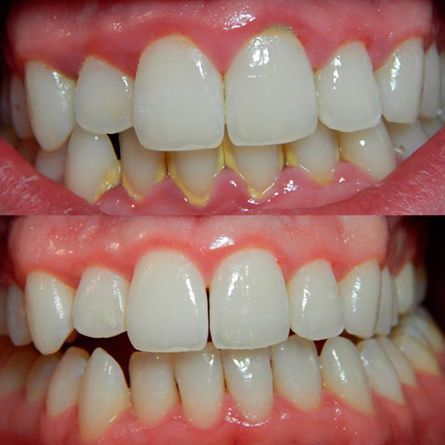 Scaling & Root Planning (Deep Cleaning)