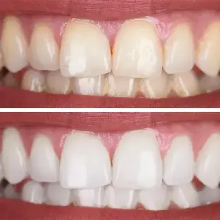 Teeth Whitening Before and After