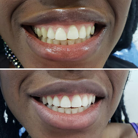 Teeth Whitening Before and After