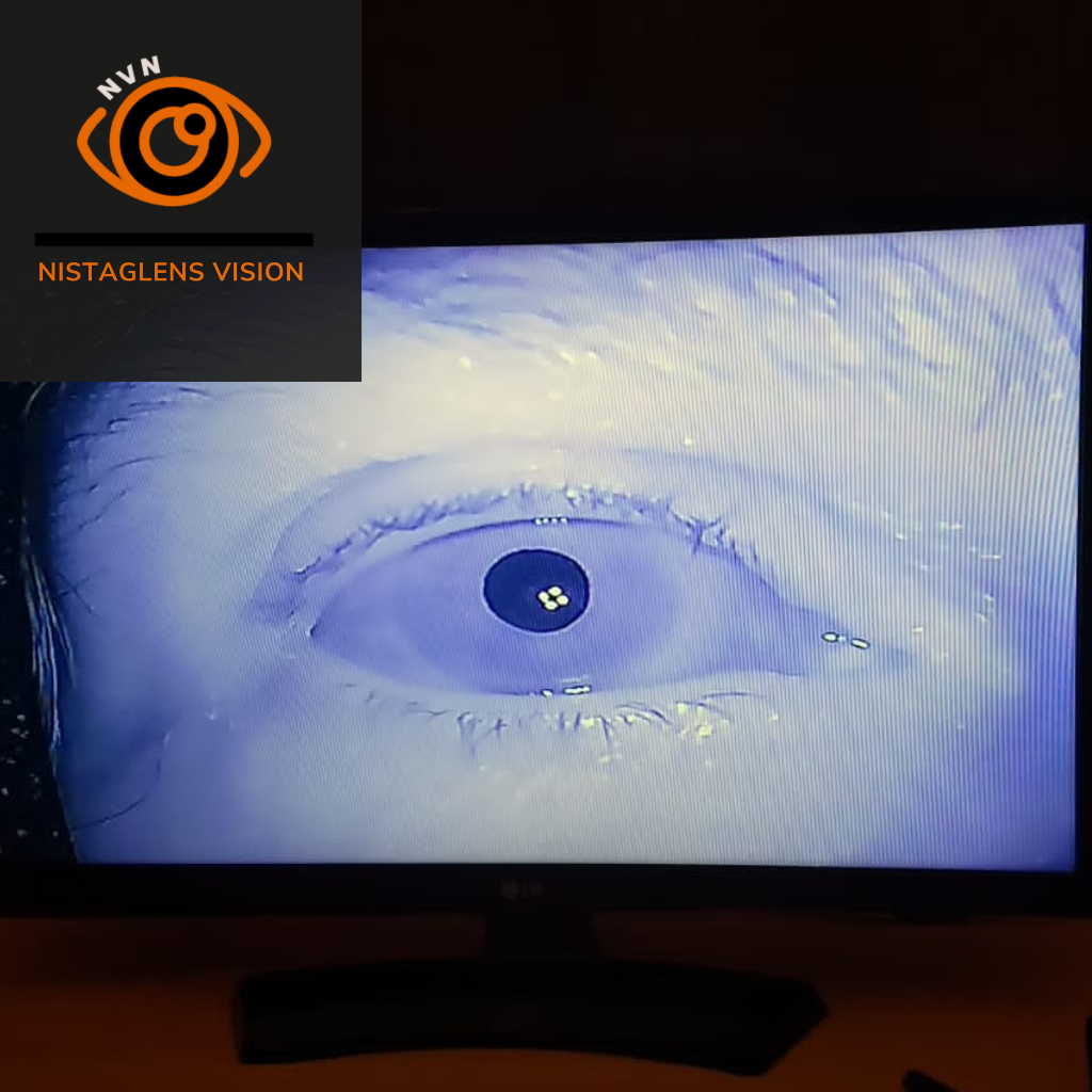 videonistagmoscopio binocular