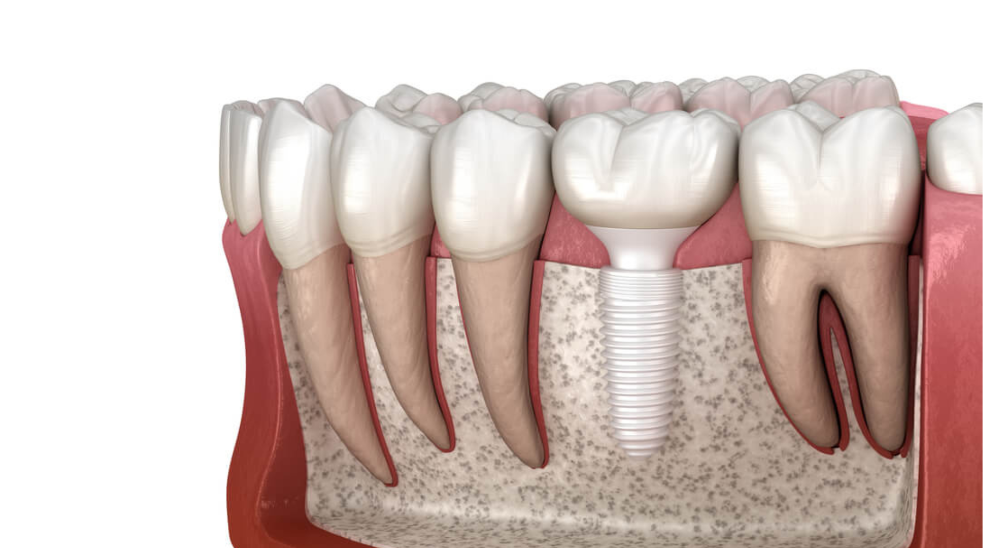 Holistic Tooth Replacement With Zirconia Dental Implants : Tetra Health Dentistry