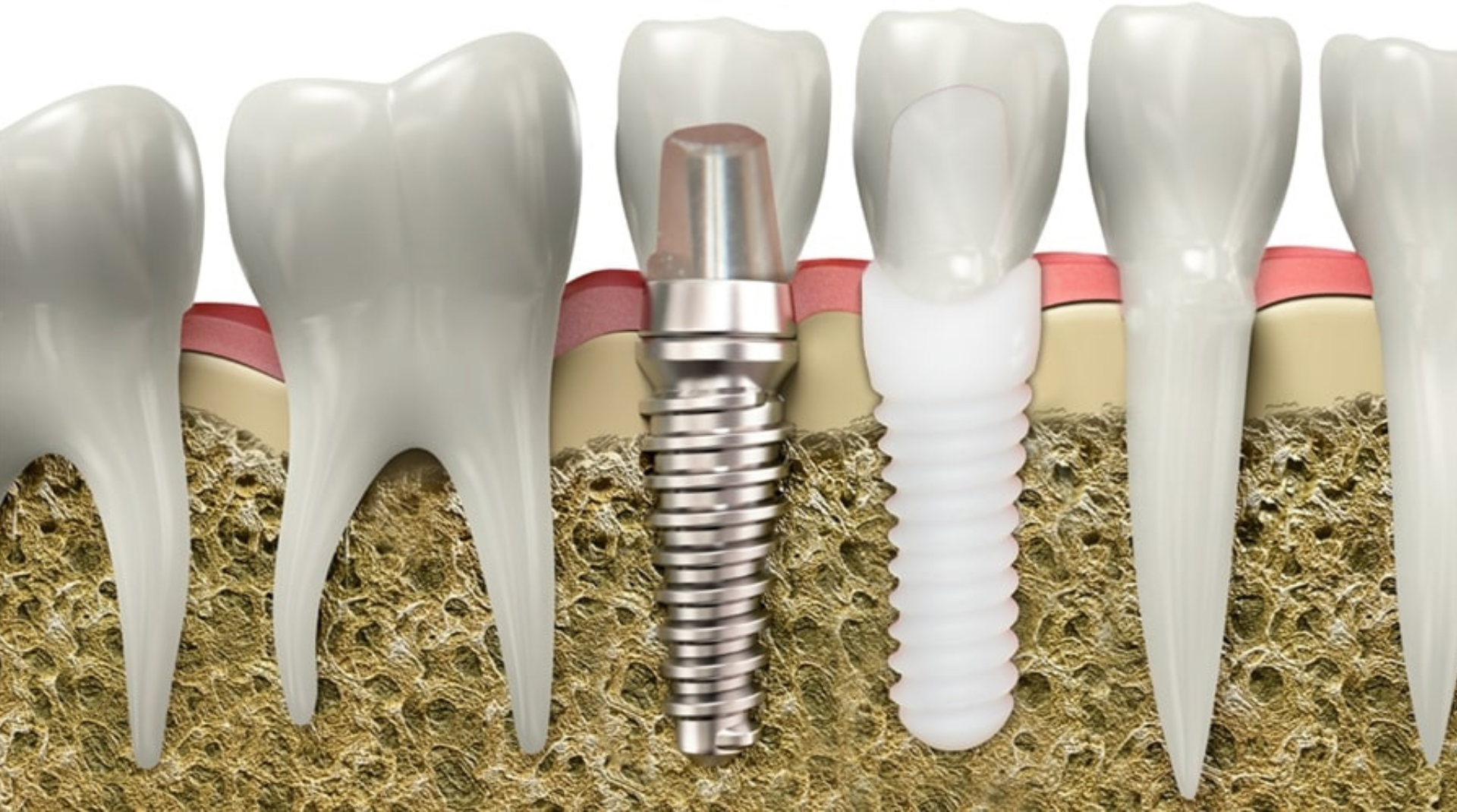 How Do Zirconia Dental Implants Compare to Traditional Titanium Implants?