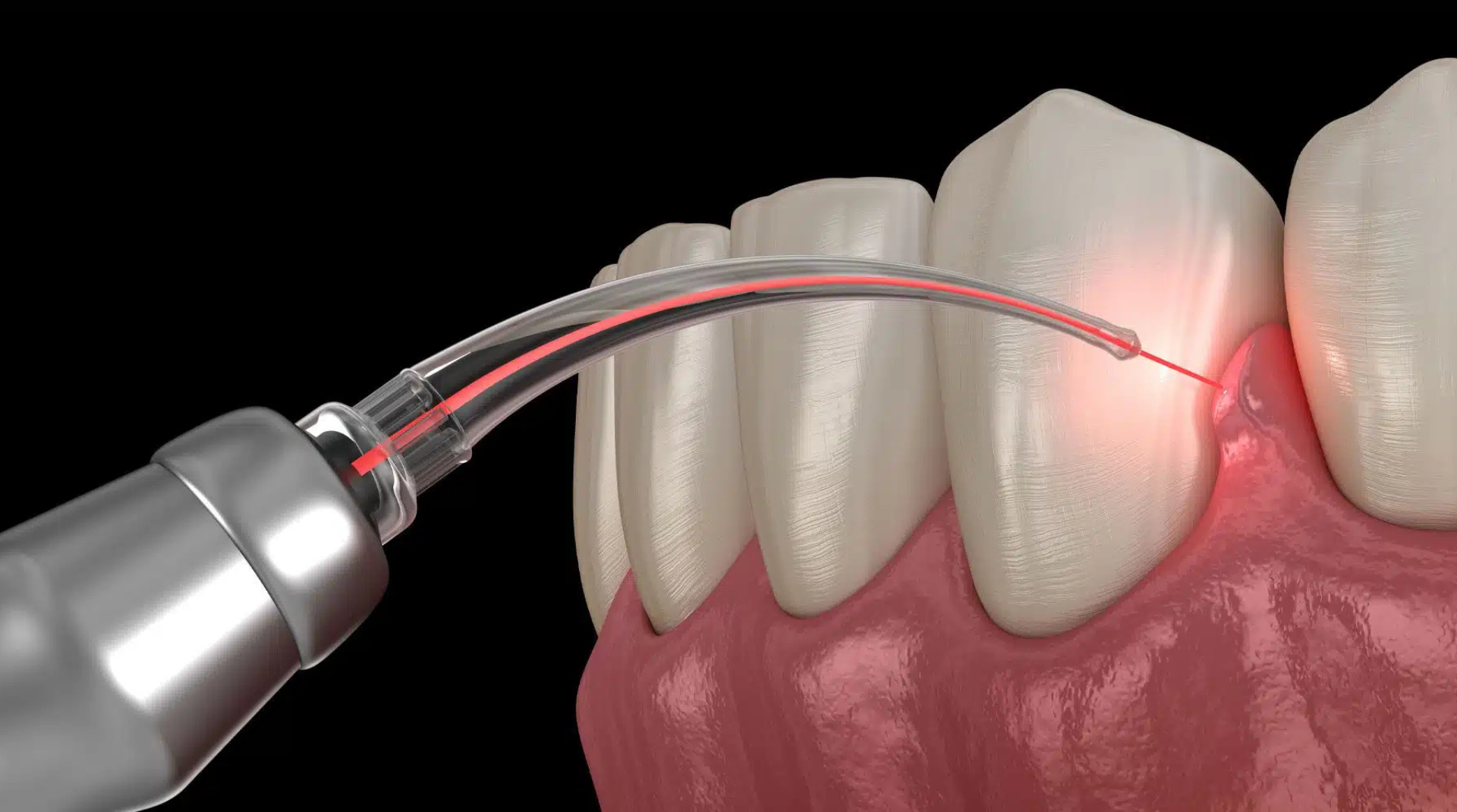 How Osseous Surgery Works And Why You Shouldn’t Fear It : Tetrahealth™