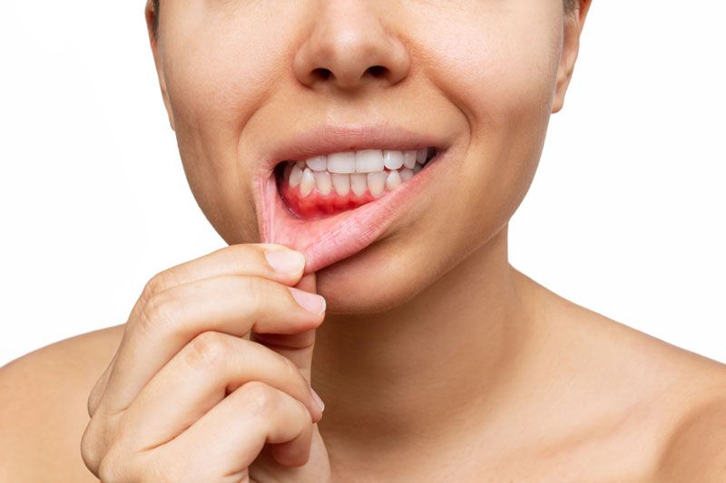 gum disease being shown 
