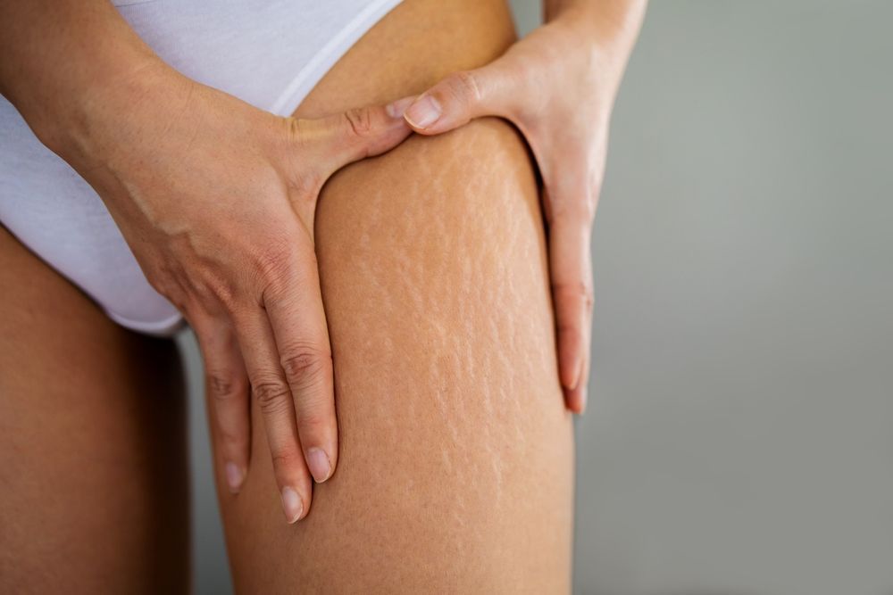 Hands applying lotion to a leg with visible dry skin and stretch marks