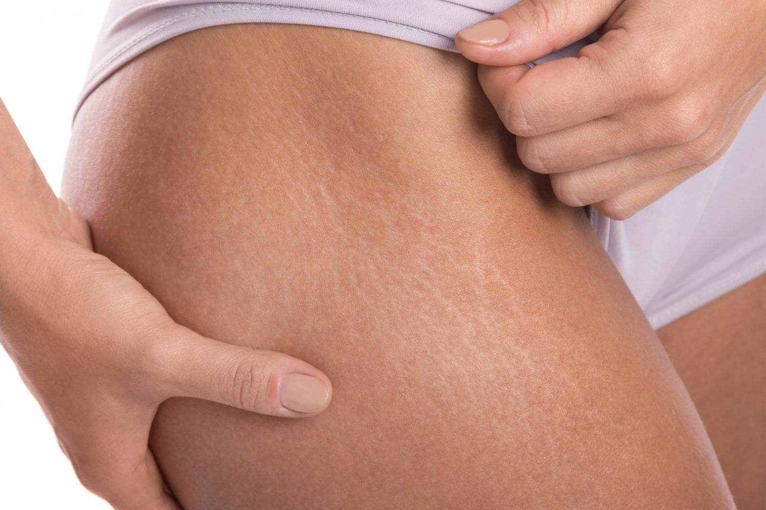 A woman is holding her leg with stretch marks on it.