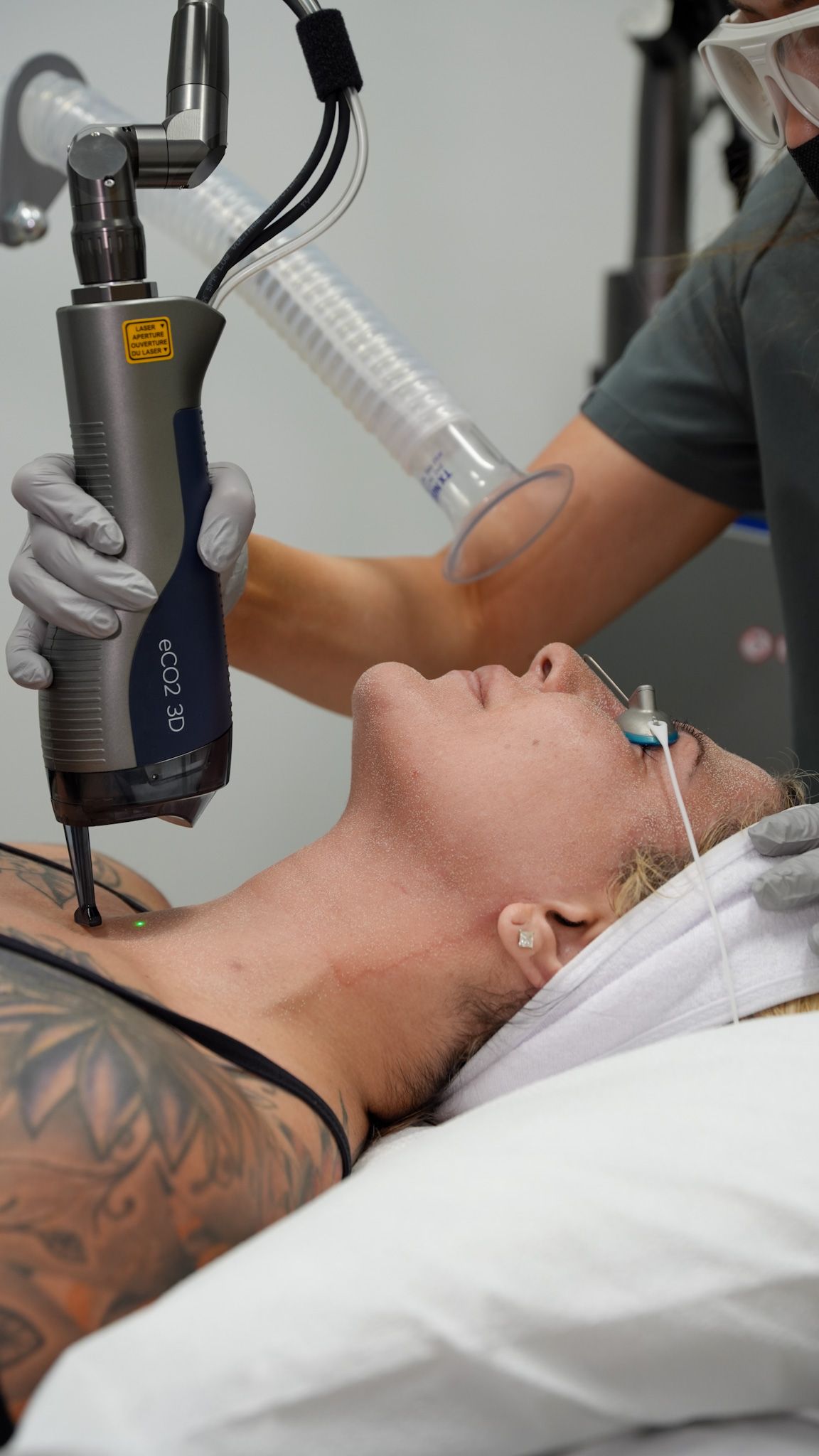 c02 laser huntington beach