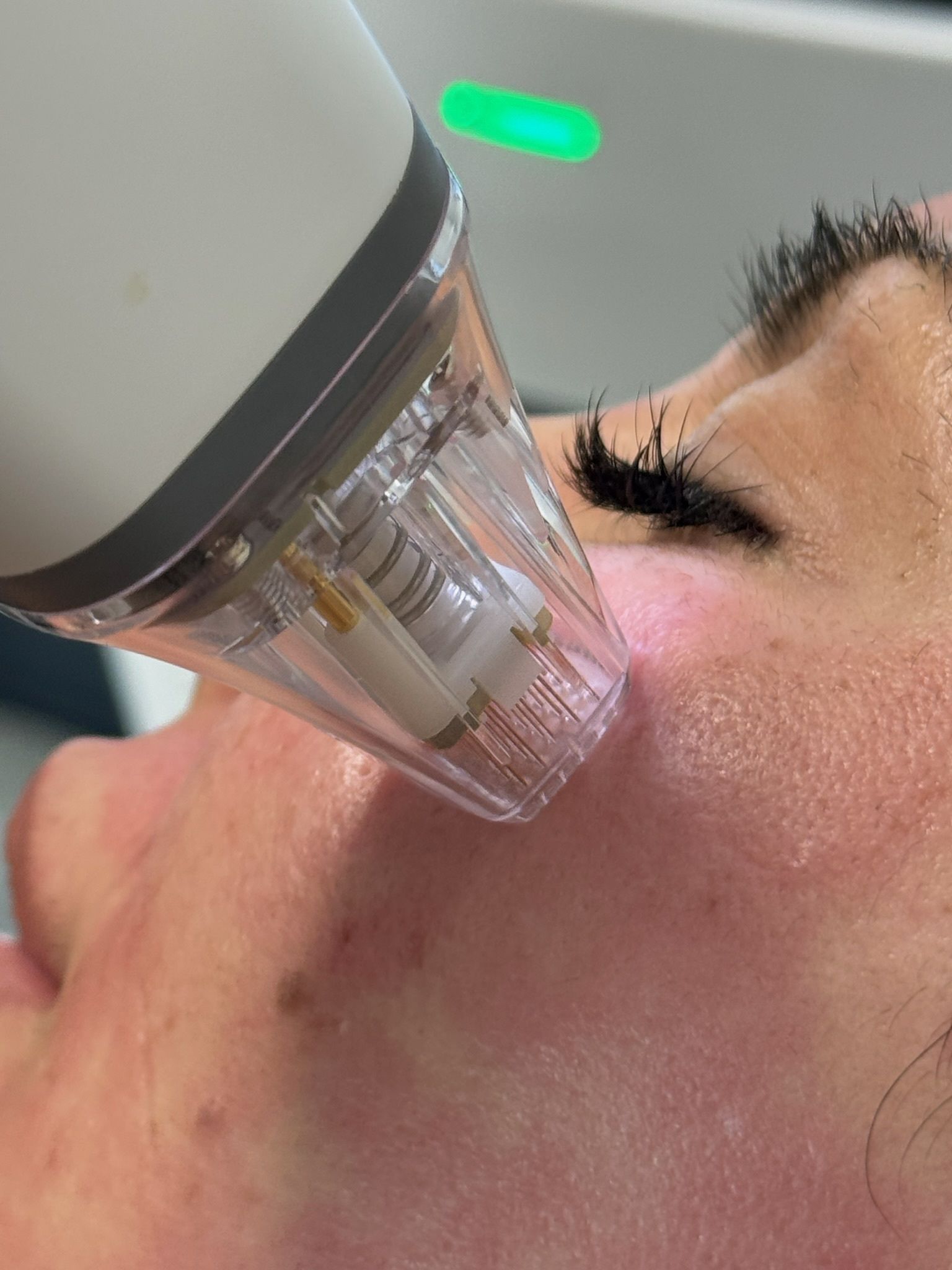 potenza microneedling