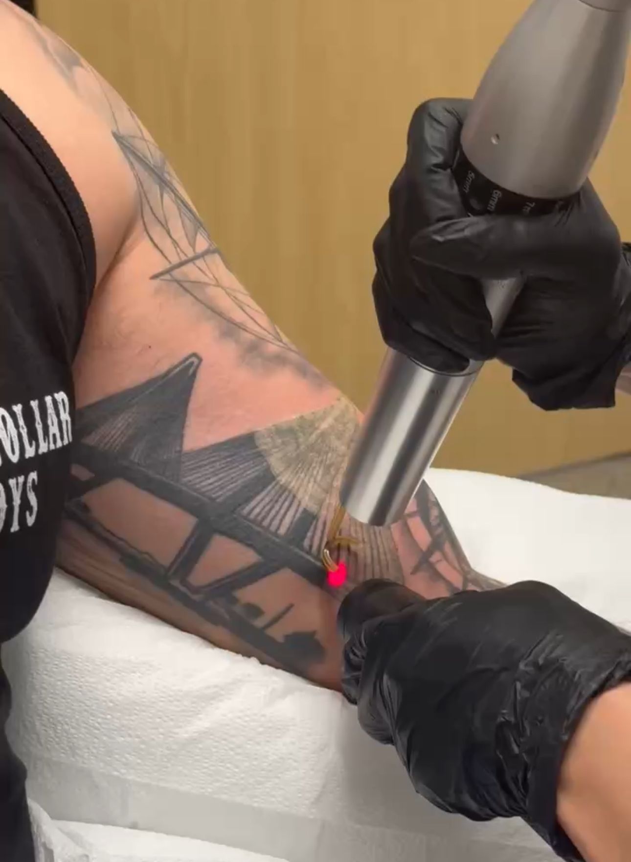 laser tattoo removal