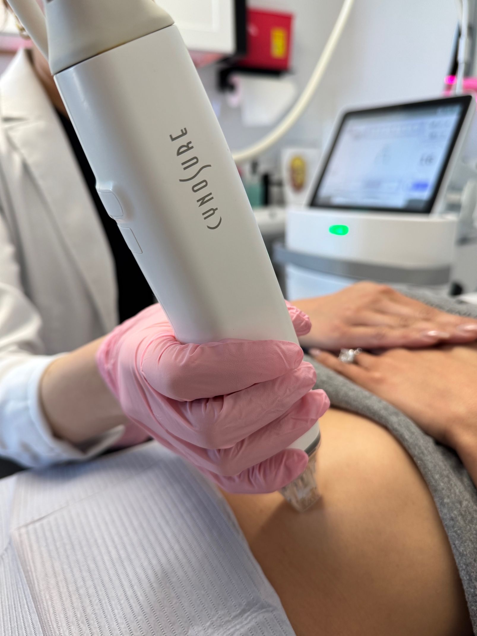 A woman is getting a RF microneedling treatment at a med spa