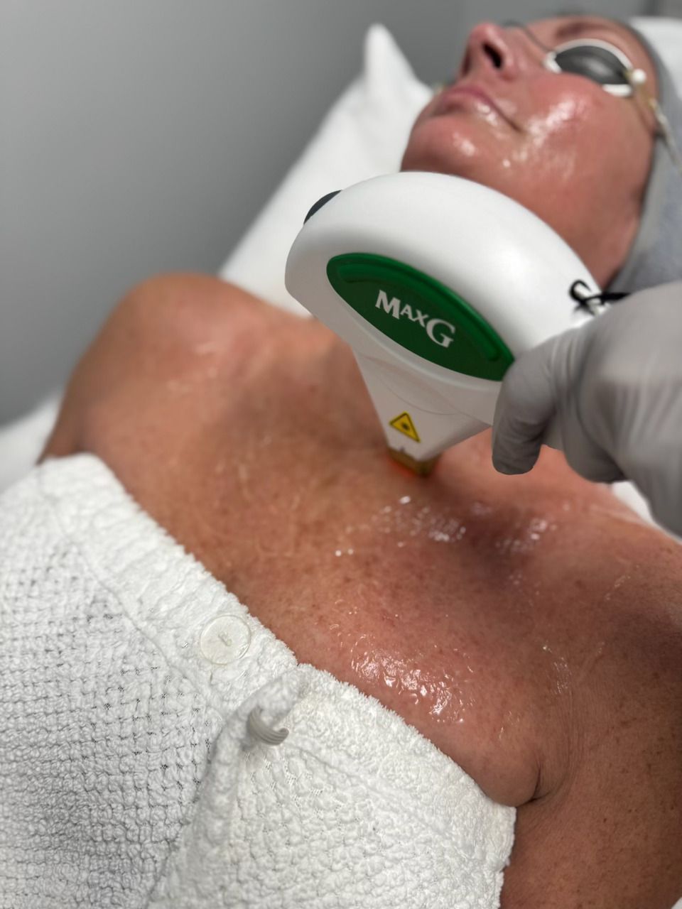 stretch mark removal huntington beach