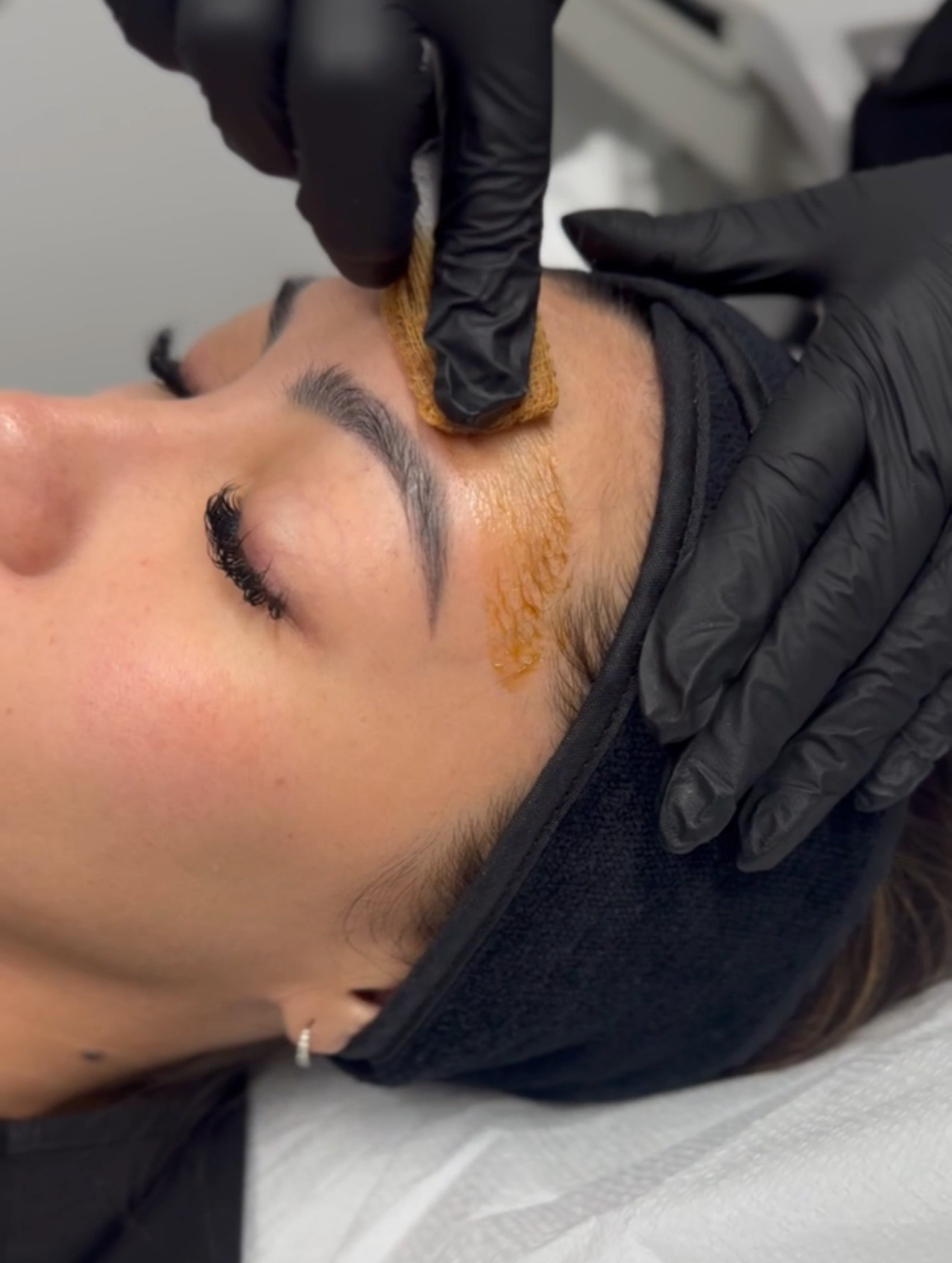 chemical peel huntington beach