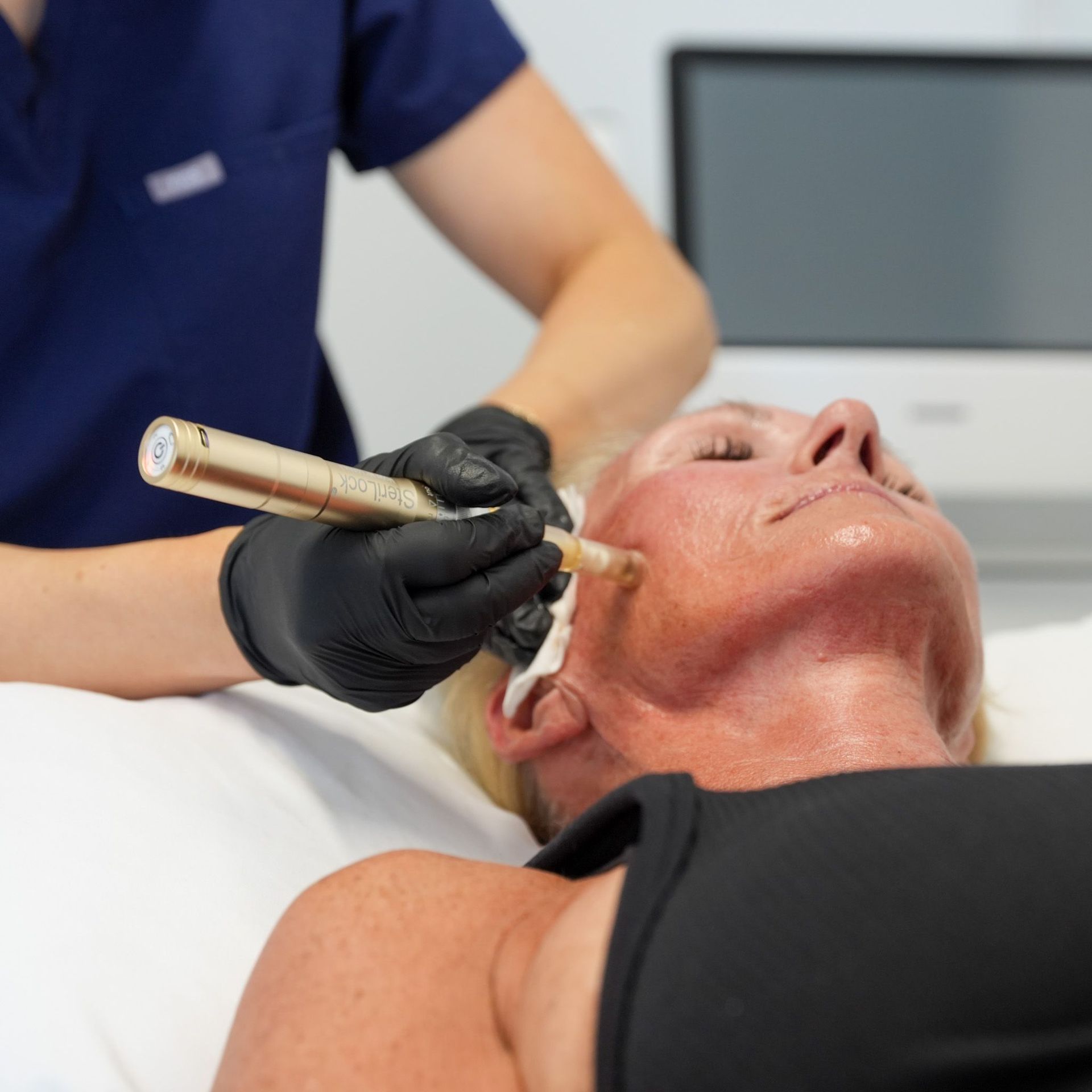 A woman is getting a microneedling treatment with a dermapen.