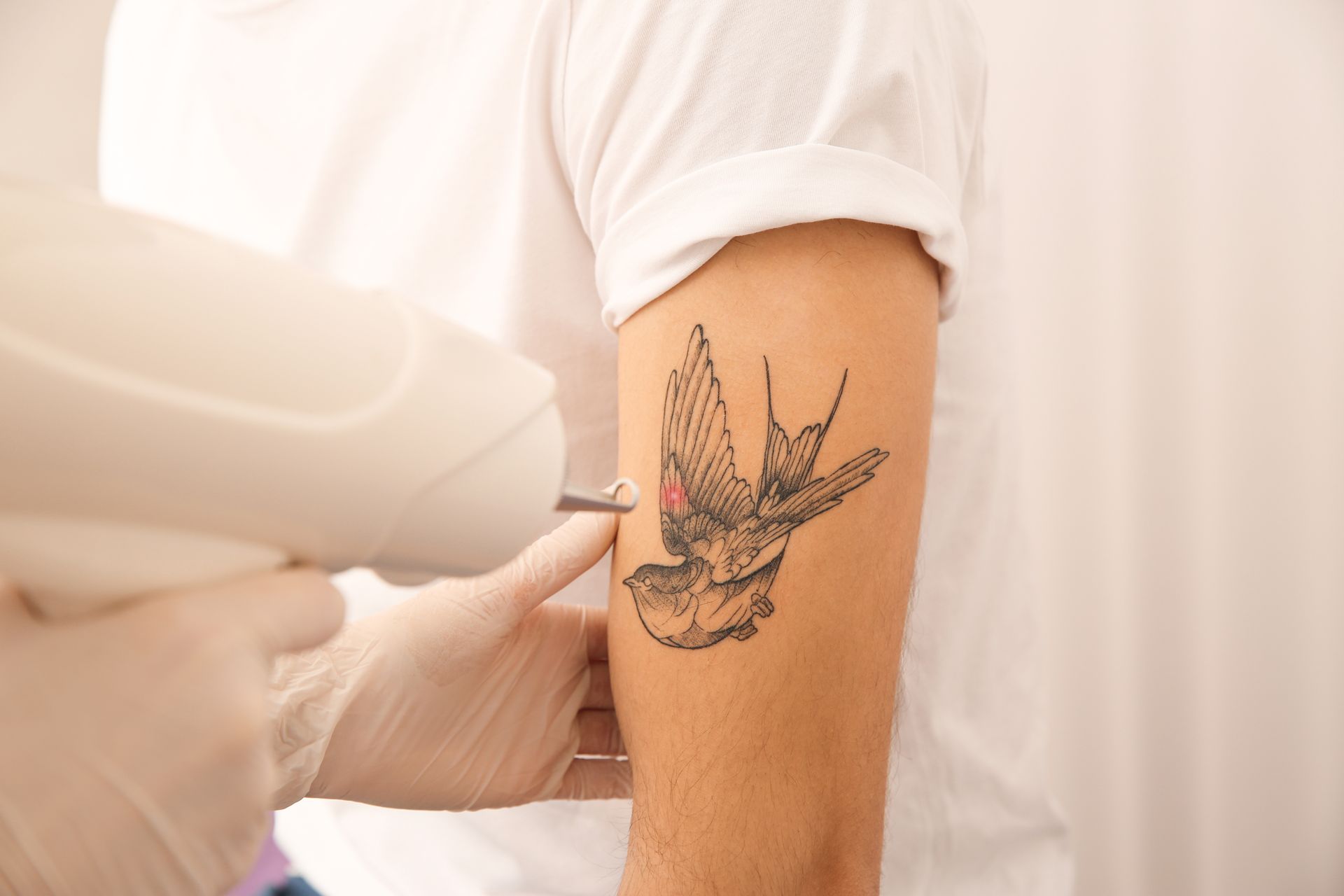 Tattoo removal laser treating a bird tattoo on an arm