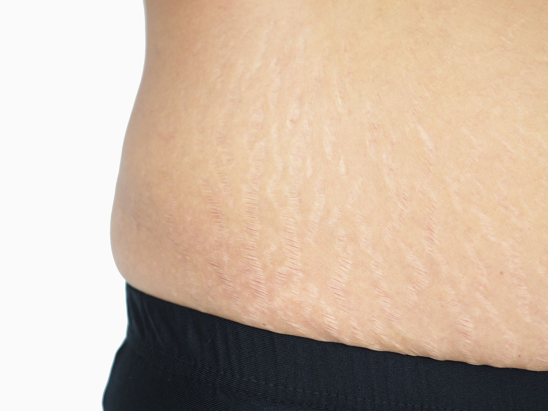 Close-up of a person's bare midsection above a black waistband, showing stretch marks on skin