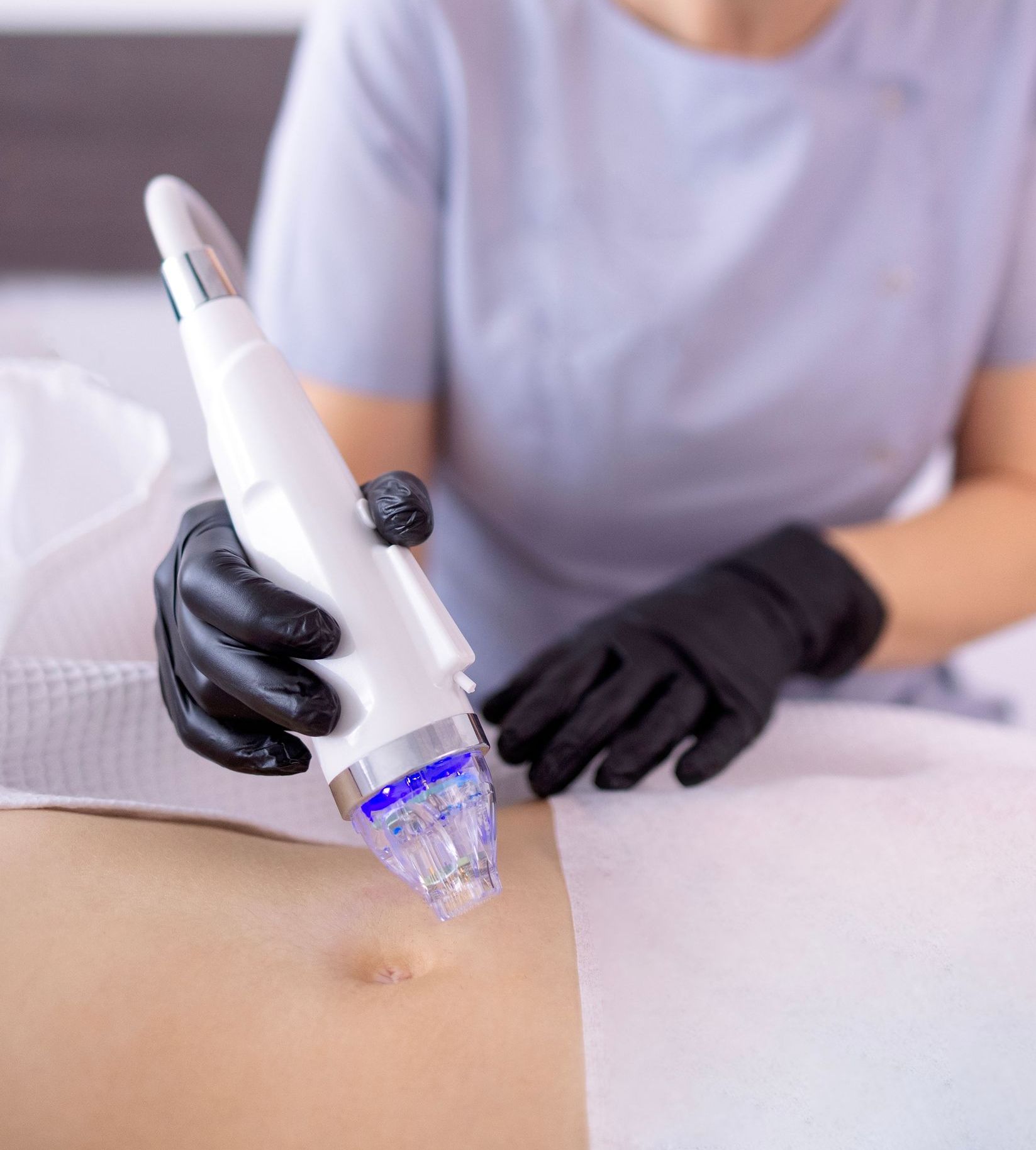 A woman is getting a RF microneedling treatment at a med spa