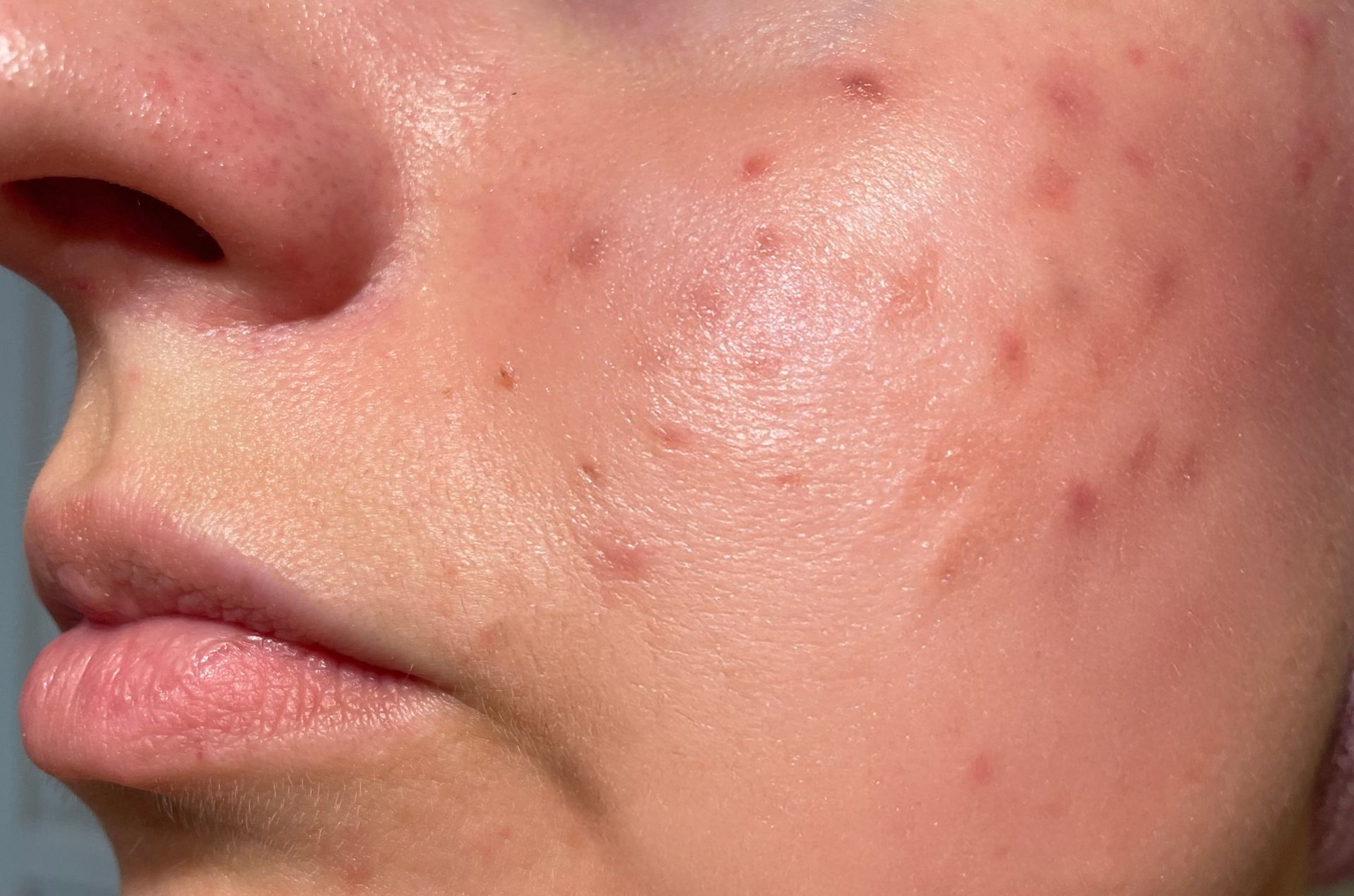 Close-up of a cheek with acne, redness, and skin texture visible