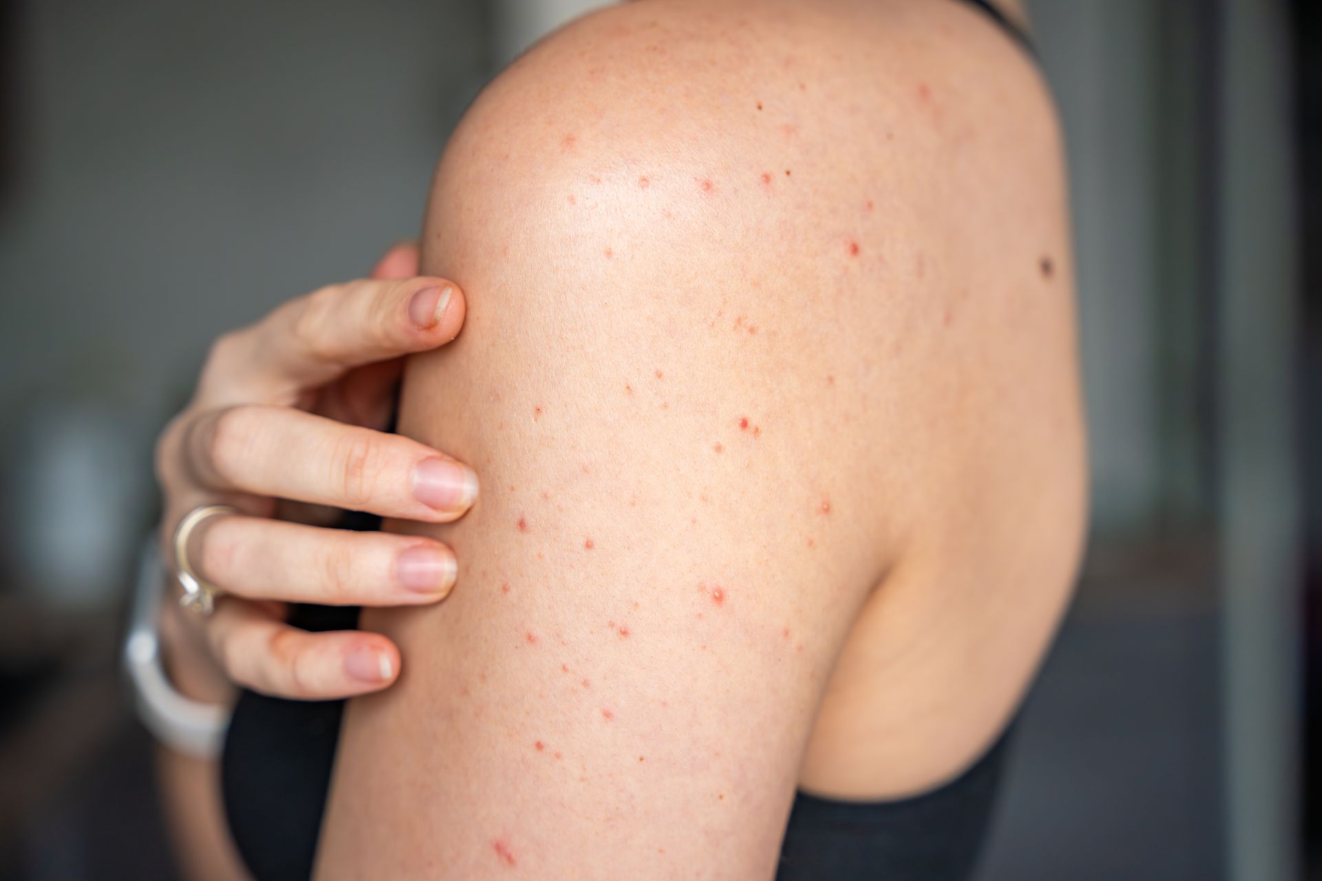 Close-up of a shoulder with a hand touching it, showing several small red spots on the skin.