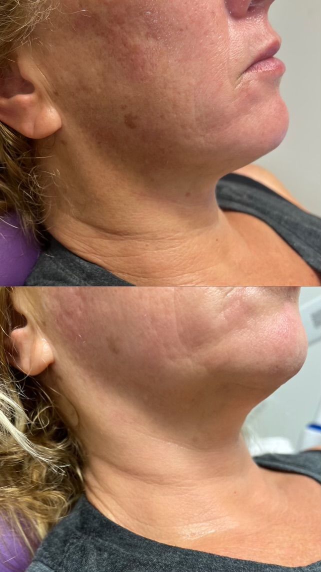 A before and after photo of a woman 's neck and face.