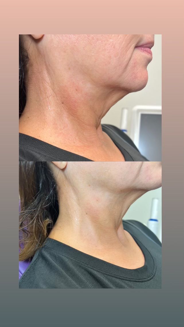 A before and after photo of a woman 's neck and face.