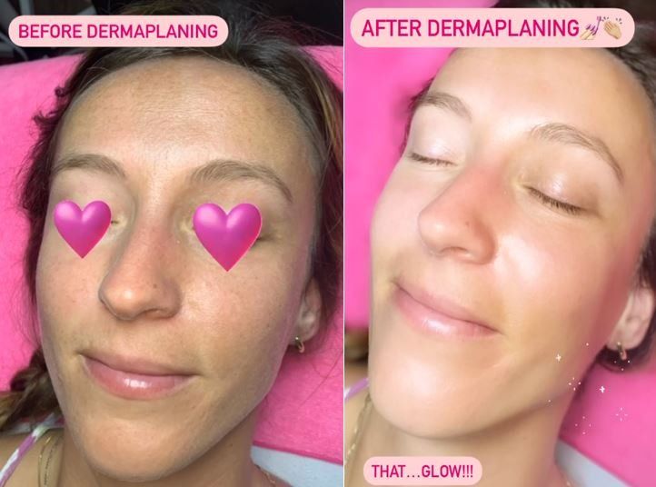 before and after dermaplaning