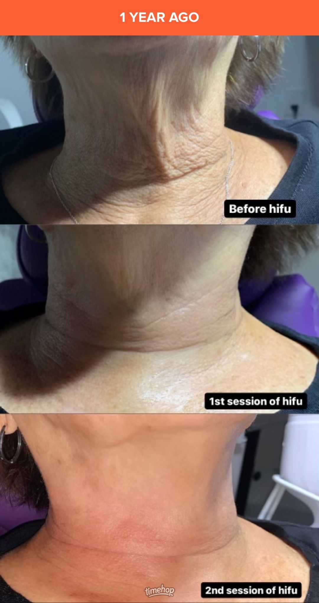 A woman 's neck is shown before and after a treatment.
