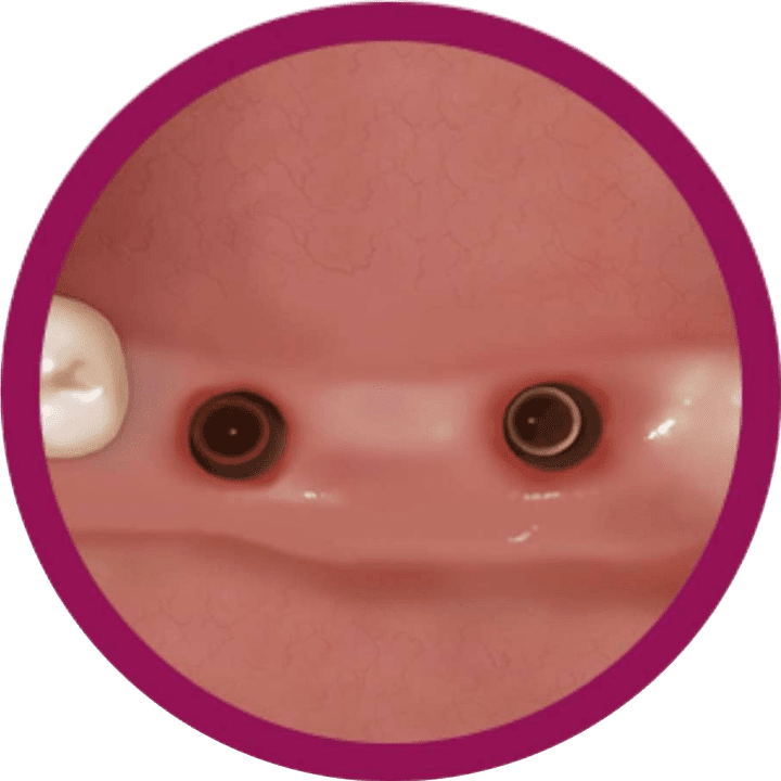 implantología dental