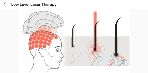 Low Level Laser Hair Therapy Diagram