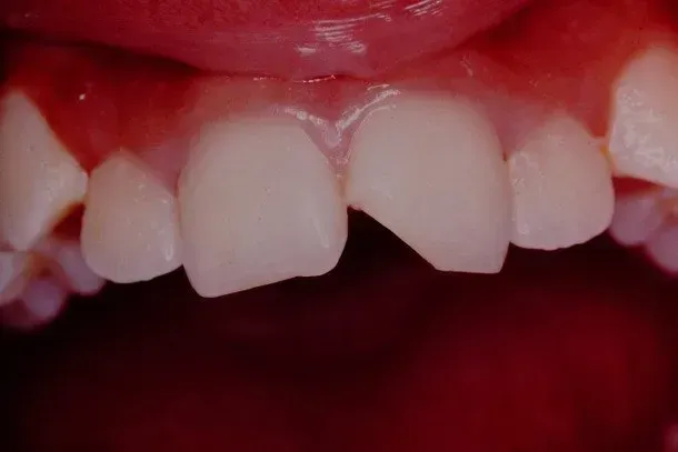 A close up of a person 's teeth with a broken tooth.